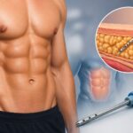 Struggling to Get Abs? 6-Pack Liposuction Explained